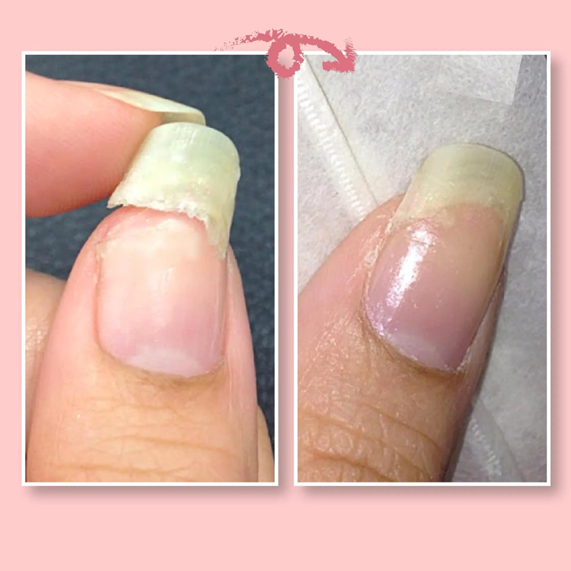 NailRescue - Schutzgel für die Nagelreparatur | 50% RABATT