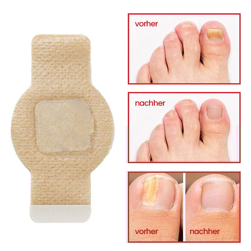 Pilz Nagelpflaster für Zehennagelpilz Linderung | 60+60 GRATIS