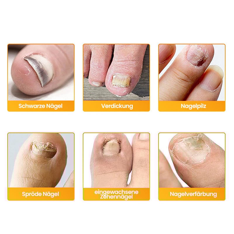Pilz Nagelpflaster für Zehennagelpilz Linderung | 60+60 GRATIS