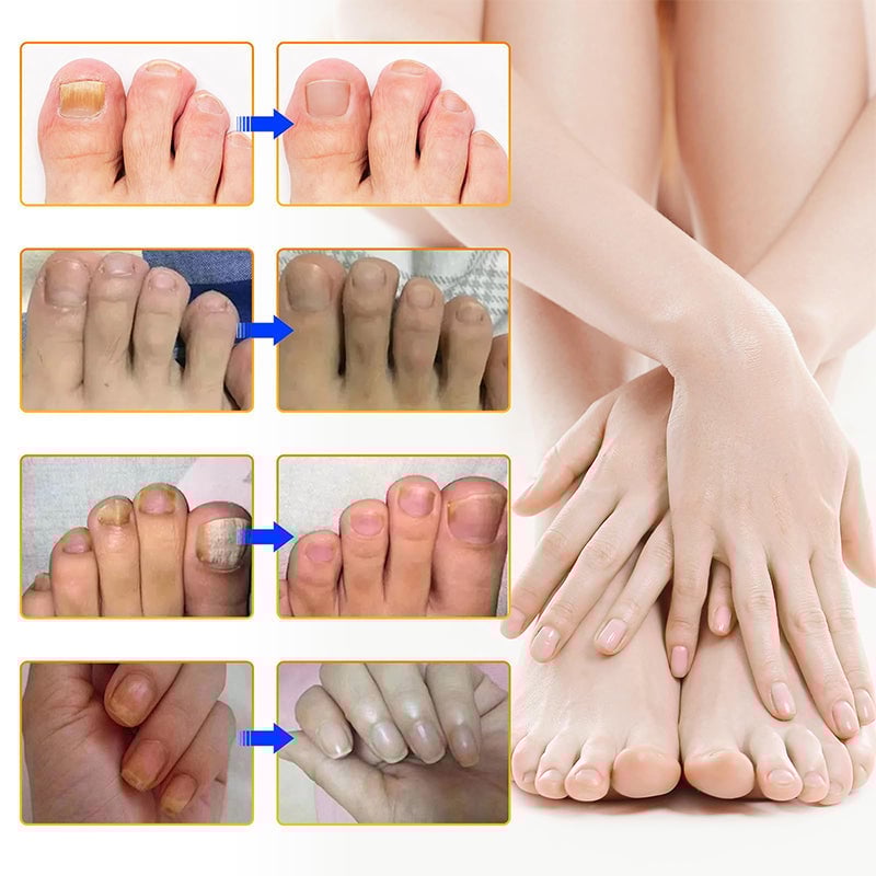 Pilz Nagelpflaster für Zehennagelpilz Linderung | 60+60 GRATIS