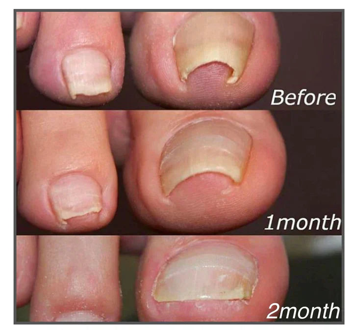 Nagelreparatur-Pflaster - Sofortige Schmerzlinderung & Gesundes Nagelwachstum